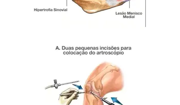 Ajudar Pedro Lucas  fazer a cirugia