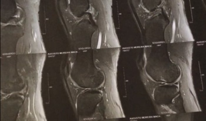 custear minha cirugia no joelho 🙏🖤