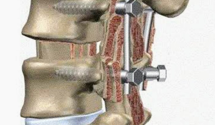 CiRUGIA DE ARTRODESE DA COLUNA L4 e L5  COM 2 PINOS,(Vertebra ficou estática)