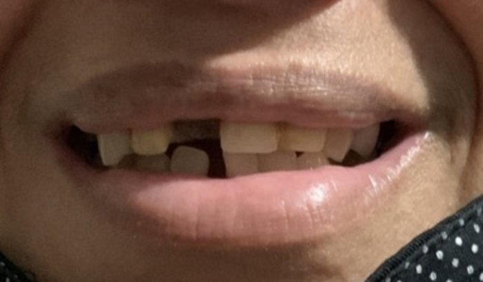Implante dentário meu sonho 