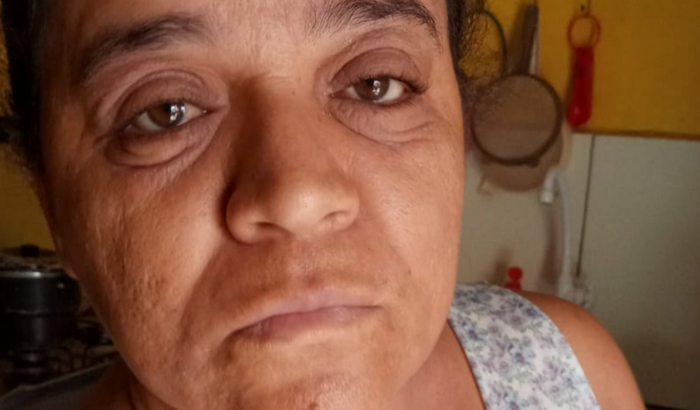 Ajudar minha mãe está com uma doença na pele chamada " DERMATITE ESPONGIÓTICA SUBAGUDA COM DERRAME PIGMENTAR"
