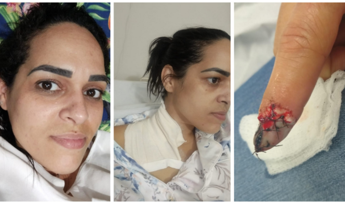 TRATAMENTO CANCER MELANOMA MALIGNO