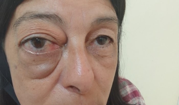 ajude a Zaira na Cirurgia para retirada de TUMOR na REGIÃO DO OLHO DIREITO.