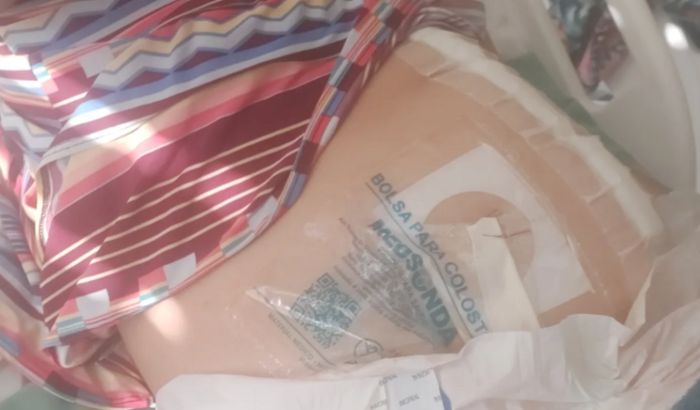 Ajuda de custo para pós-operatório de laparotomia com colotomia direta