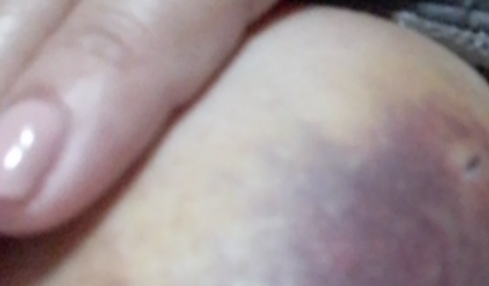 Cirurgia da minha mama direita retirada do nódulo