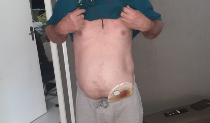 Arrecadar dinheiro para cirurgia de reconstrução de intestino..