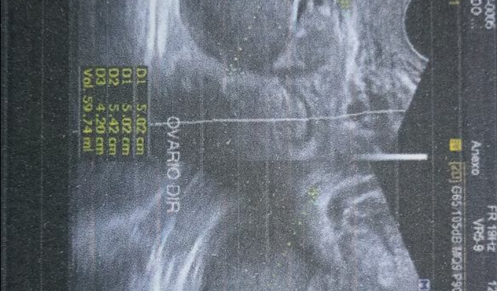 Cirurgia de urgência para retirada de focos de endometriose