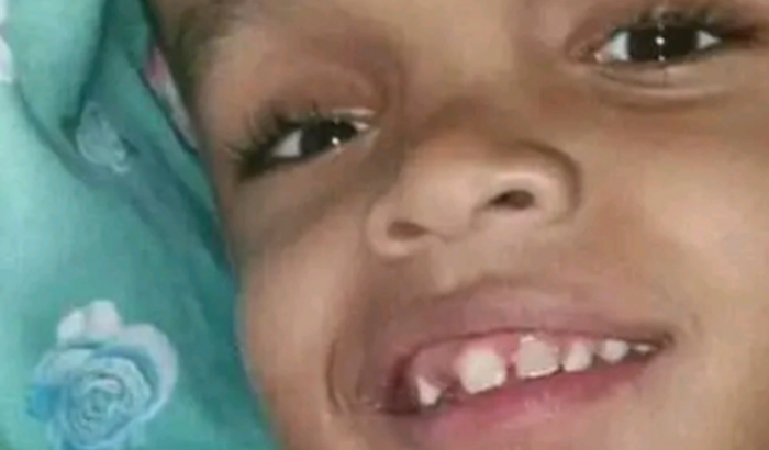 Criança com indrocefalia 