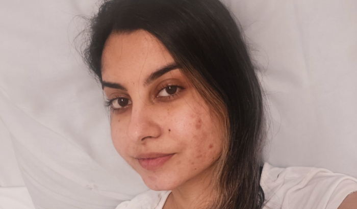 Internação para tratamento de Retocolite Ulcerativa