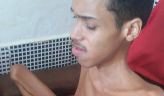 Suplementação para paciente com distrofia muscular de Duchenne