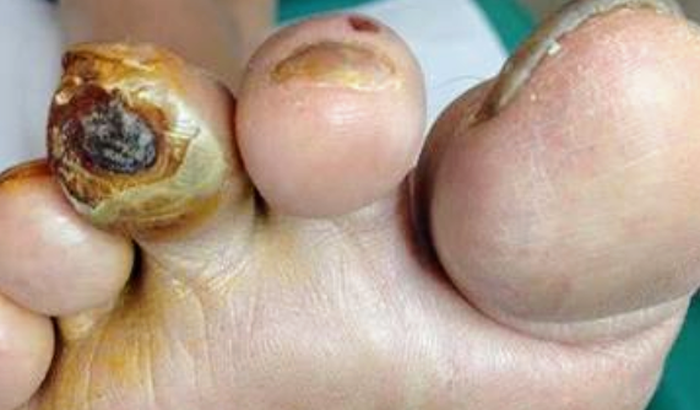 Podologia para Idosos Carentes e Diabetes Mellitus