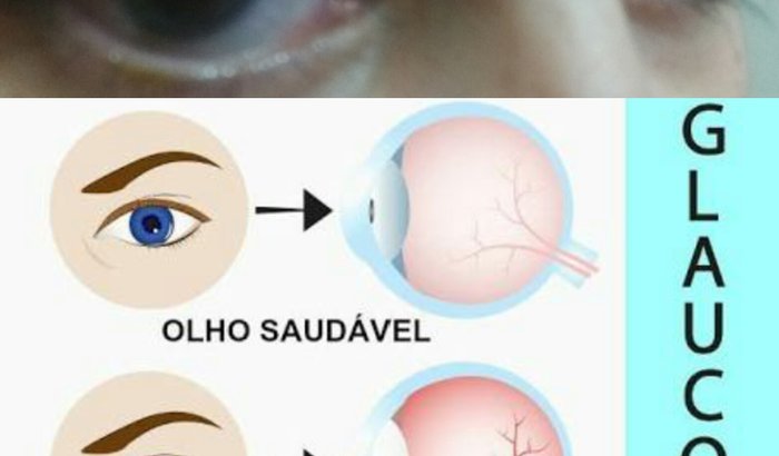 Cirurgia Glaucoma