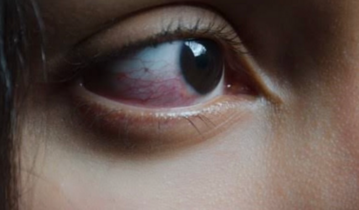 Cirurgia Ocular de Maria Júlia