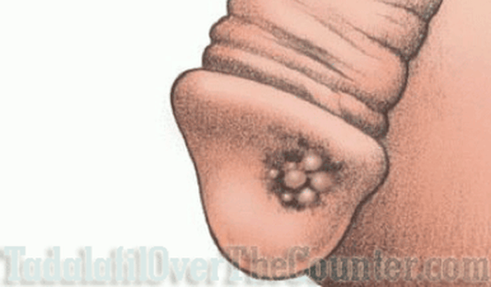 CIRURGIA CÂNCER PÊNIS