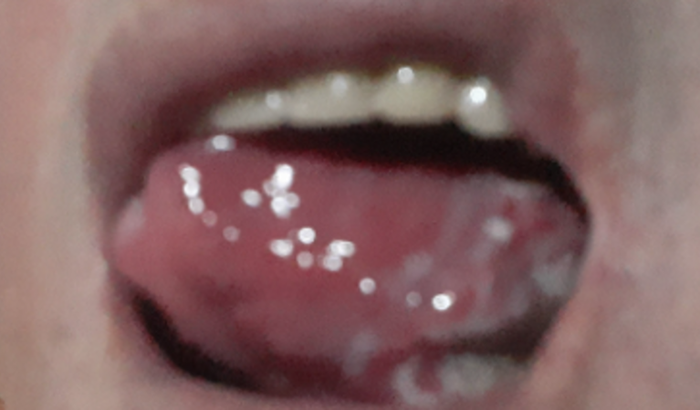 AJUDA  MELHOR QUALIDADE DE VIDA ( CÂNCER DE LÍNGUA)