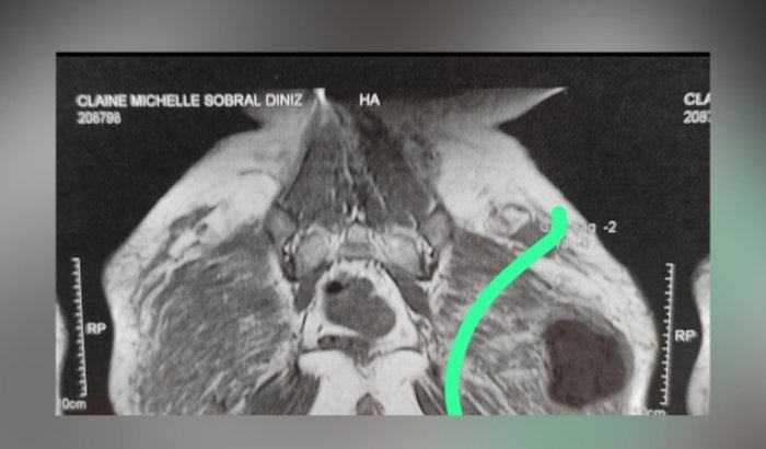 NÓDULO  CIRURGIA GLÚTEO URGENTE(METACRIL)