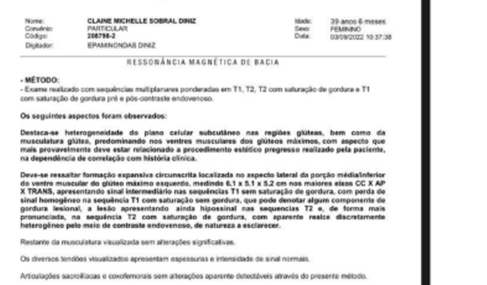CIRURGIA DE NÓDULO GLÚTEO (METACRIL)