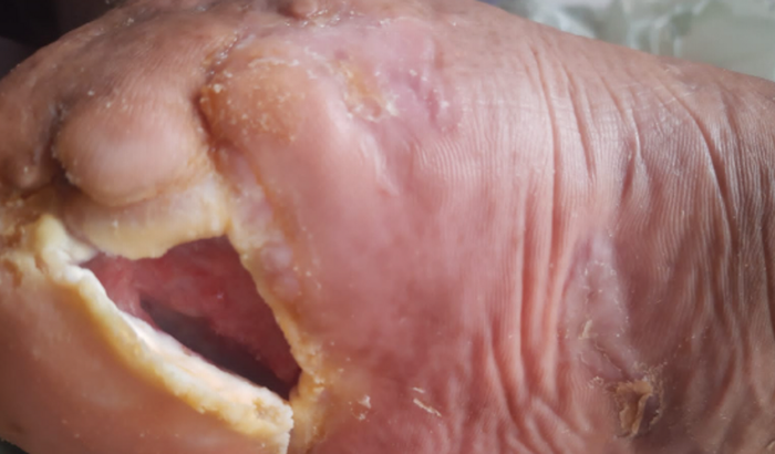 Síndrome de Down Fournier Operação colostomia