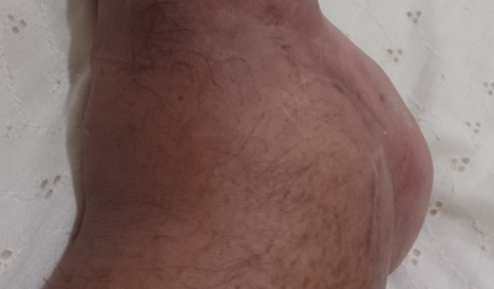 Procedimento de micro espuma para varizes