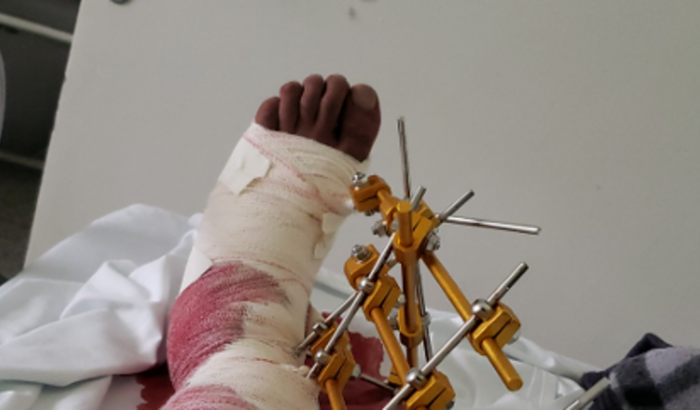 cirurgia de artroplastia de tornozelo 