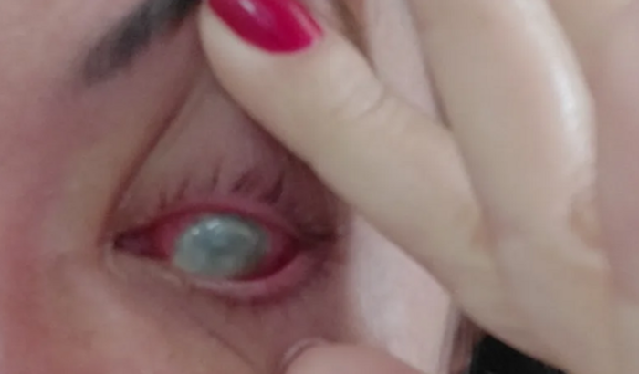 Ajuda com despesas de viagem para acompanhamento de Cornea Infectada.