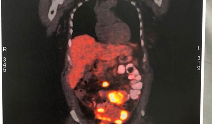 TRATAMENTO CONTRA O CÂNCER DE SHIRLEY ALENCAR