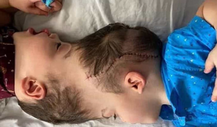 Gêmeos siameses precisam de cirurgia de separação do crânio