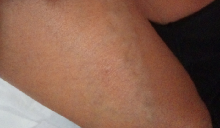 Vaquinha solidária cirurgia de varizes 