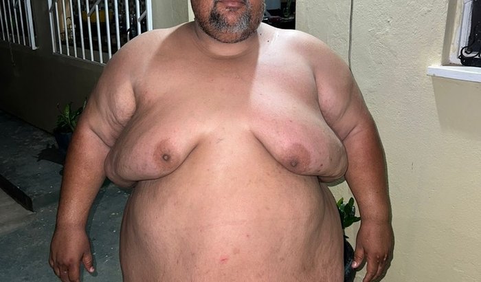 Realização de cirurgia para BALÃO GÁSTRICO.