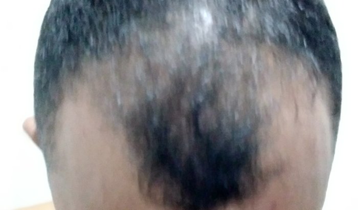 Ajudeme a fazer um implante capilar 