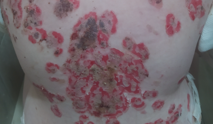 Despesas no tratamento de Pênfigo vulgar 