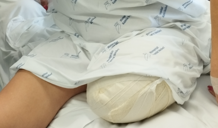 Arrecadação para prótese