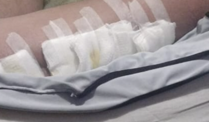 PRECISAMOS FAZER UMA CIRURGIA ( URGENCIA) FÊMUR