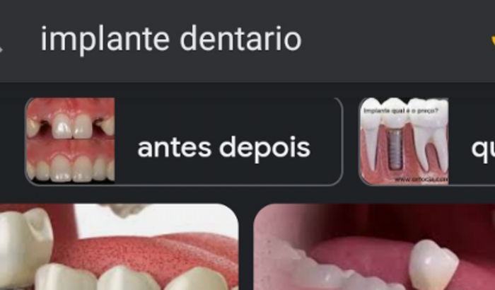 Implante dentário