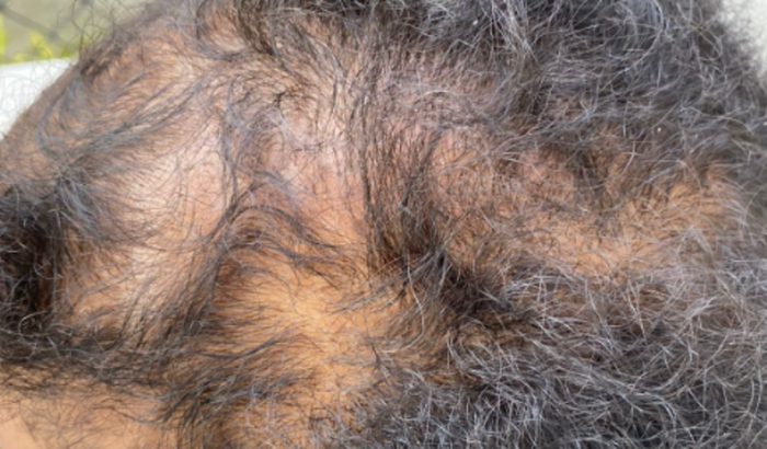 Me ajuda aumentar minha autoestima( sofro com alopécia androgenética feminina