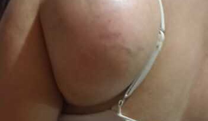 Cirurgia de cisto de gordura