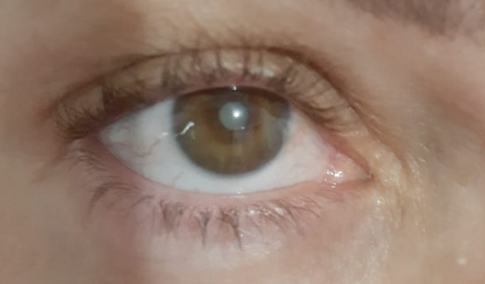 Cirurgia catarata da minha mãe.