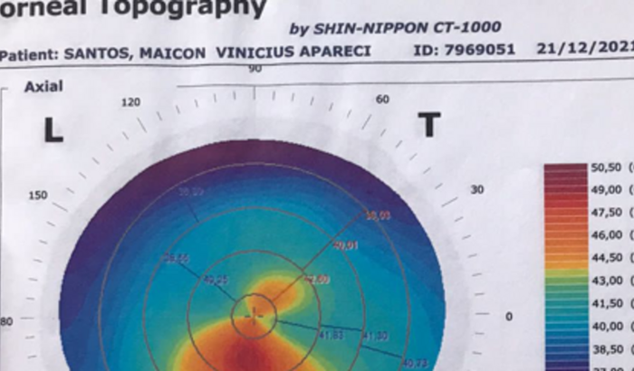 Tratamento ceratocone 