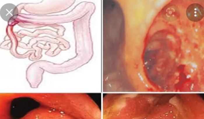 TRATAMENTO SEU AMBROSIO