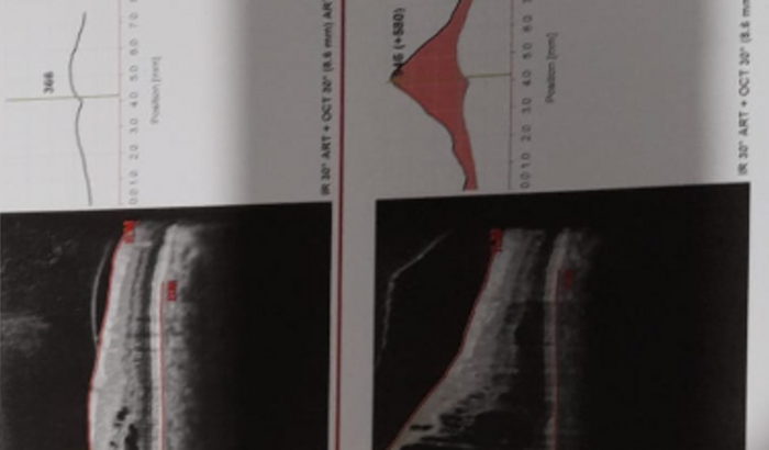 Tratamento intra-ocular 