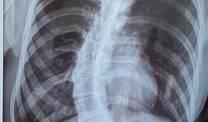 Ajuda para fazer cirurgia de escoliose