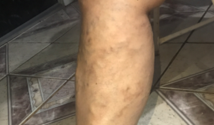 Problema circulatório nas pernas