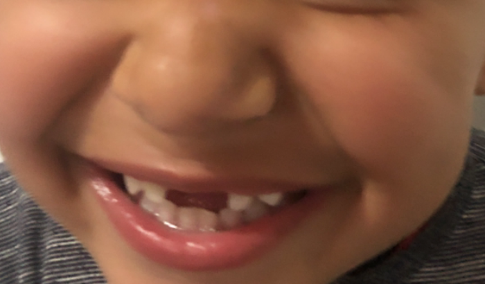 Tratamento odontológico do meu filho, Lucca Miguel que sofreu um acidente doméstico 