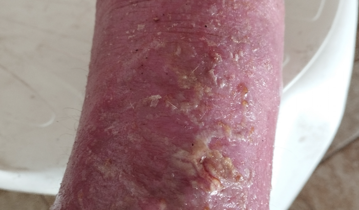 Ação para tratamento de saúde de Luiz Remontti