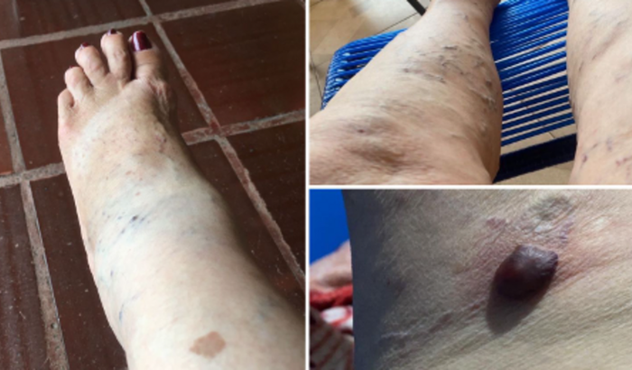 PEÇO SUA COLABORAÇÃO PARA UM PROCEDIMENTO CIRURGICO (escleroterapia com espuma)