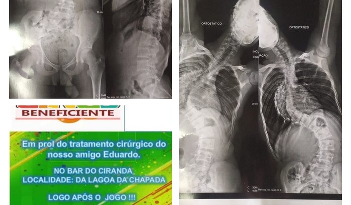 Tratamento cirurgico da coluna nosso amigo Eduardo