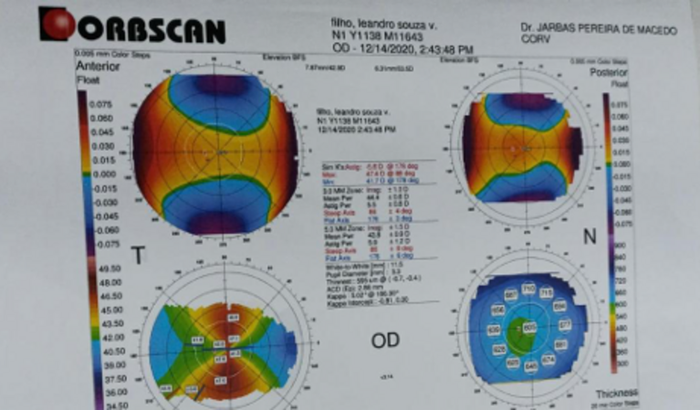 Em prol de uma cirurgia no olho, ceratocone