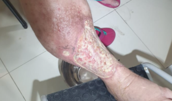 Preciso de ajuda para evitar de amputar a minha perna