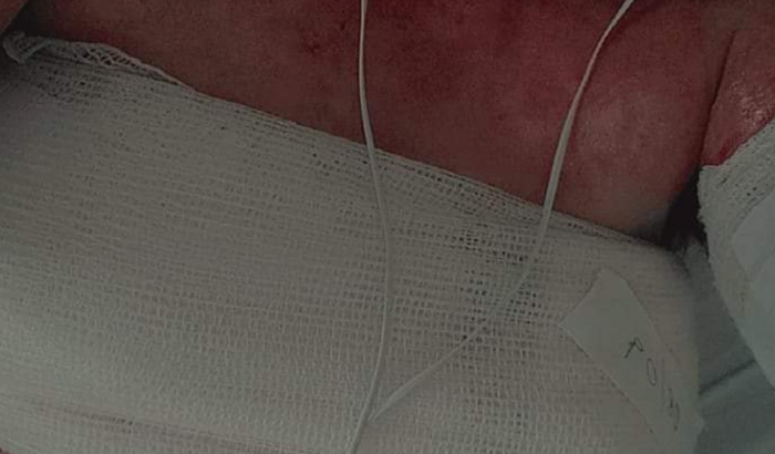 Tratando Corpo Queimado