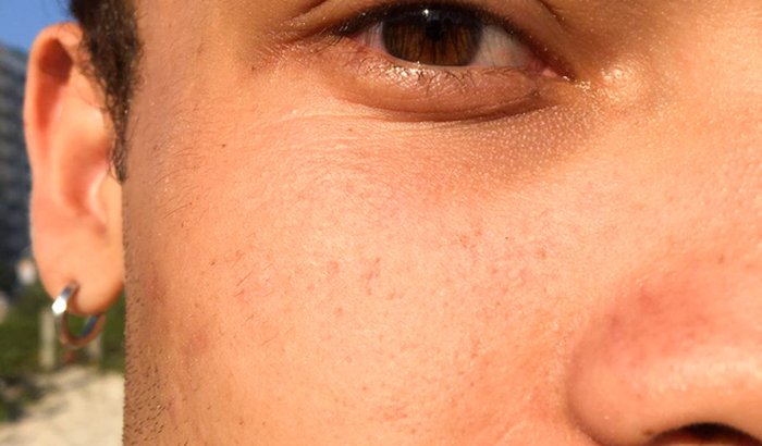 Ajuda pra minha lente de ceratocone